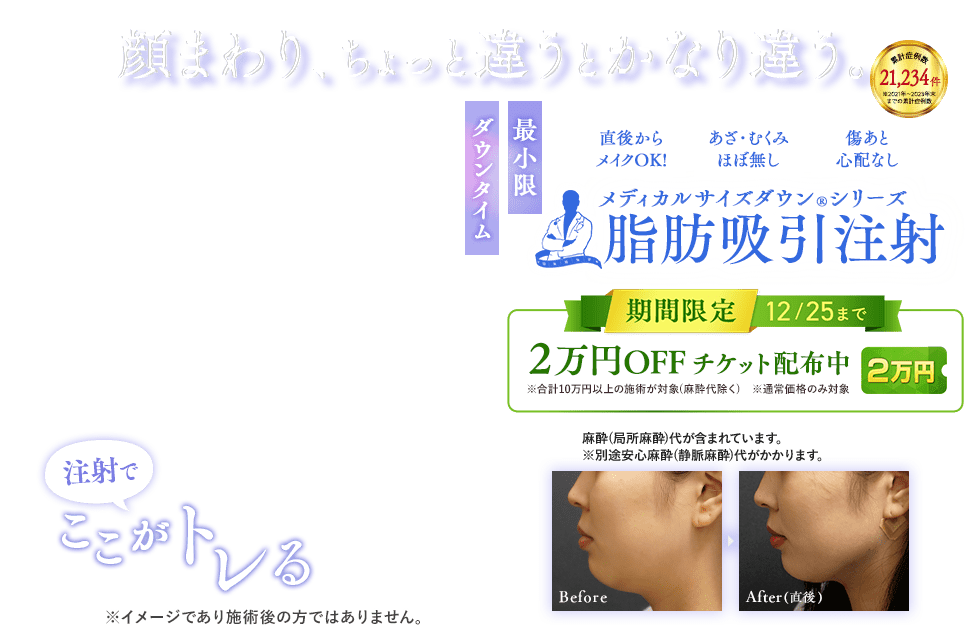 小顔用脂肪吸引注射